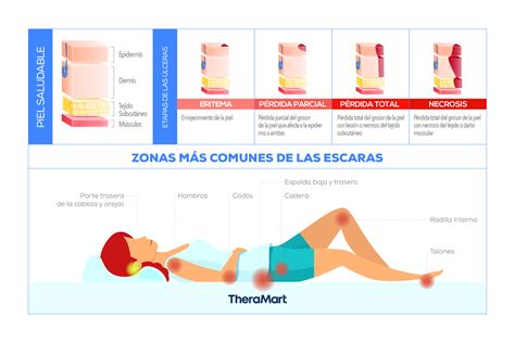 Zonas comunes de aparición de escaras en el cuerpo