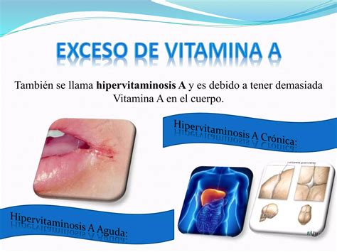 Señales de toxicidad por exceso de vitamina A