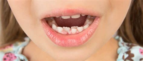 Ilustración de dientes de tiburón en niños