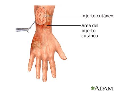 Esquema de aplicación de injerto de piel biológica en paciente quemado