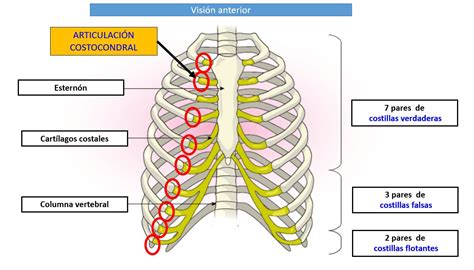 Esquema de la inflamación de los cartílagos costales