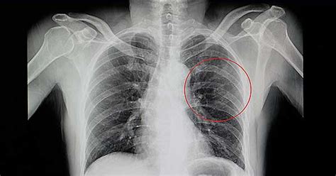 Radiografía de una costilla fracturada