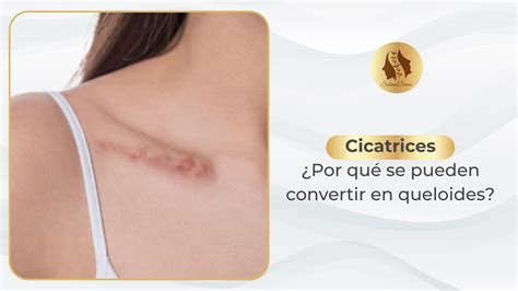 Ejemplos de cicatrices queloides en la piel