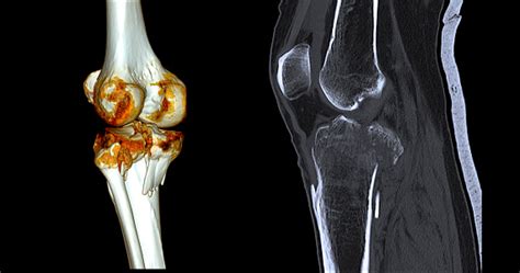 Tomografía computarizada de una fractura nasoorbitoetmoidal (NOE)