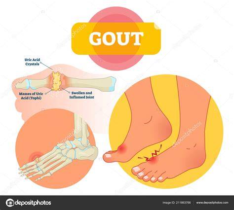 Articulación inflamada por gota