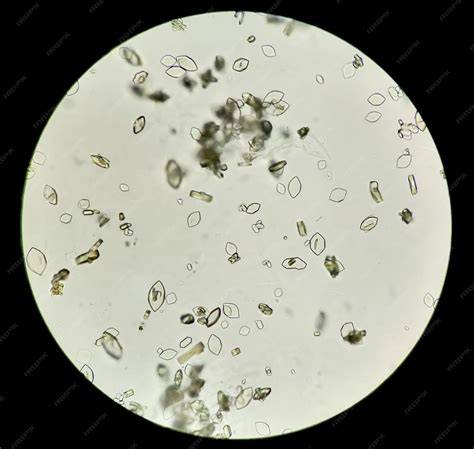Cristales de ácido úrico vistos al microscopio