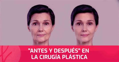 Comparación de la silueta antes y después de la cirugía de costillas flotantes