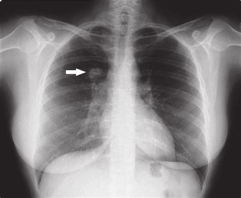Radiografía de tórax mostrando un nódulo pulmonar