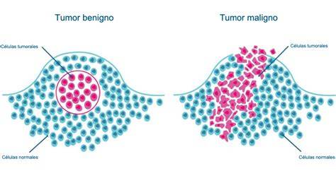 Esquema comparativo de nódulos benignos frente a malignos