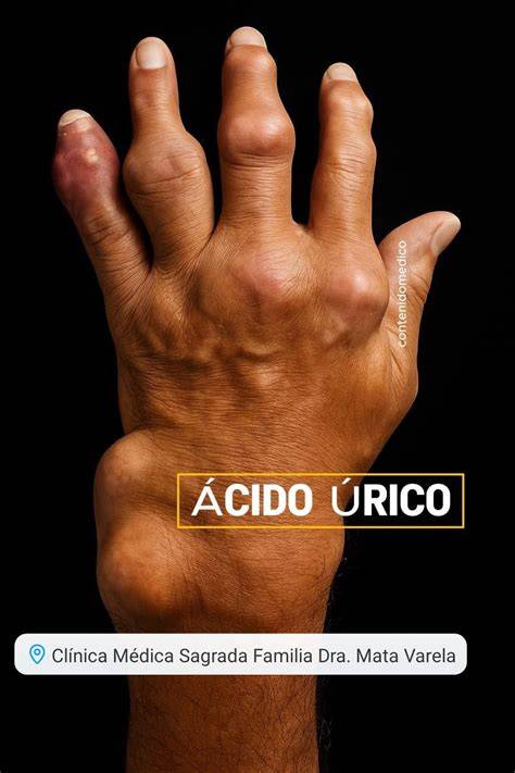 Cristales de ácido úrico en una articulación