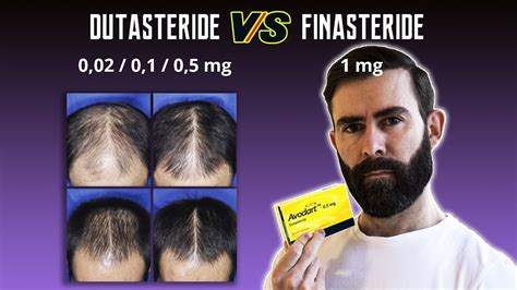 Tabla comparativa de Finasterida y Dutasterida