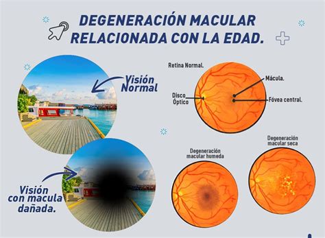 Ojo humano y los efectos de la degeneración macular