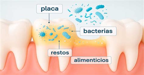 Ilustración de placa bacteriana y sarro dental