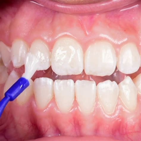 Imagen de aplicación de flúor en dientes