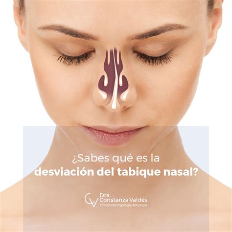 Imagen de una perforación del tabique nasal por consumo de cocaína