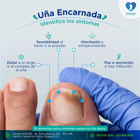 Esquema de una uña encarnada