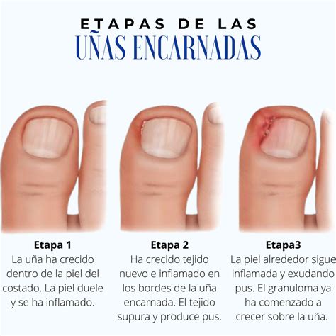 Proceso quirúrgico de una uña encarnada