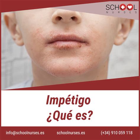 Diferentes tipos de impétigo en niños