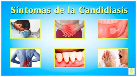 Esquema de las causas y síntomas de la candidiasis