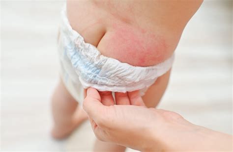 Bebé con dermatitis del pañal