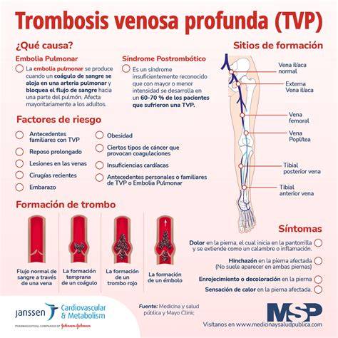 Infografía mostrando los síntomas comunes de la TVP en una pierna.