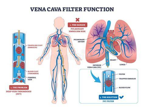 Diagrama de un filtro de vena cava.