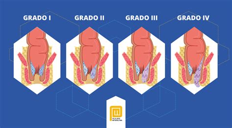 Diagrama de las diferentes clasificaciones de hemorroides internas.