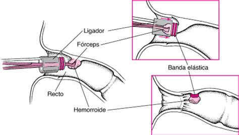 Representación gráfica de la ligadura con bandas elásticas para el tratamiento de hemorroides.