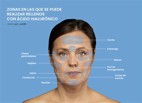 Gráfico explicando los puntos de inyección de ácido hialurónico en el mentón
