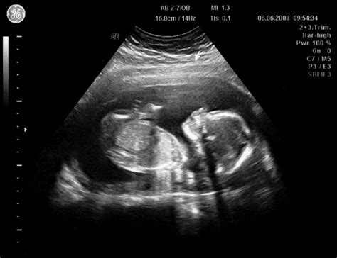 Imagen de una ecografía de bebé