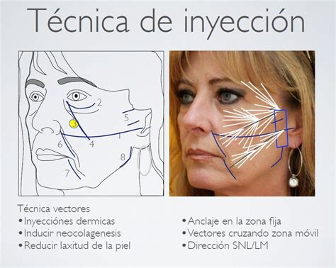 Zonas de aplicación de la hidroxiapatita cálcica en el rostro