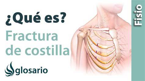 Infografía sobre los síntomas de una costilla fracturada