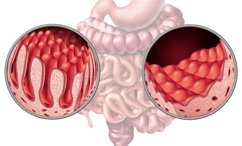 Estructura del intestino delgado y daño por gluten