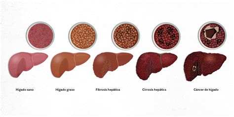 Comparación de la salud hepática en ratas según el tipo de aceite consumido