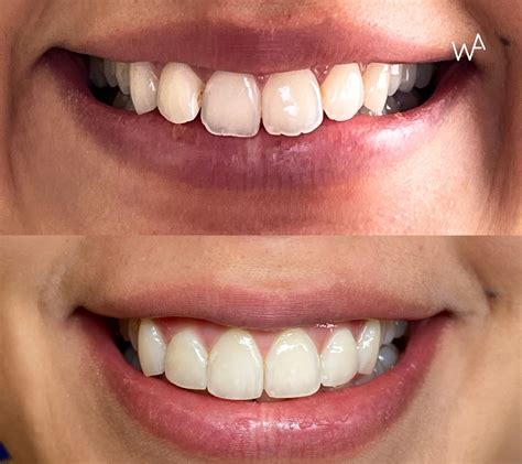 Dientes antes y después de usar pasta blanqueadora