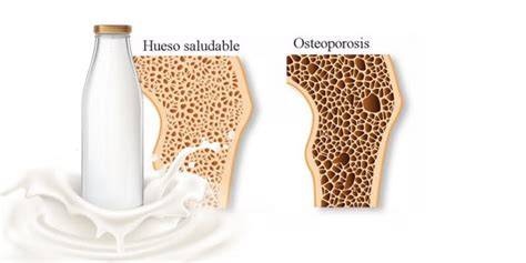 Gráfico de consumo de leche vs. osteoporosis por país