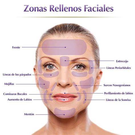 Mapa de zonas faciales tratables con rellenos