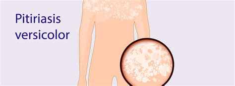 Imágenes de pitiriasis versicolor en la piel
