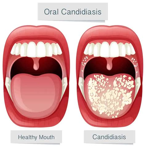 Ilustración de la candidiasis oral