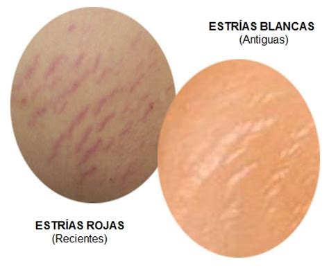 Infografía comparando estrías rojas y estrías blancas