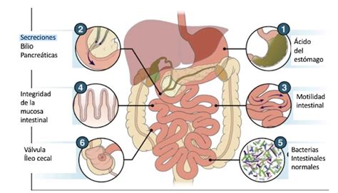Esquema del intestino delgado y el sobrecrecimiento bacteriano