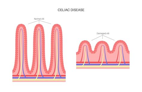 Esquema del intestino delgado con vellosidades dañadas por la celiaquía