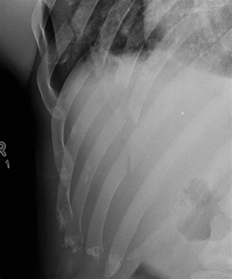 Radiografía de las costillas fracturadas de Chance Recountre