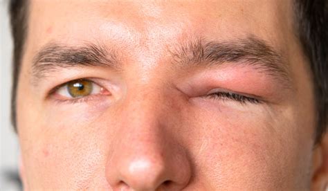 Síntomas oculares de la triquinosis: edema palpebral y hemorragias subconjuntivales