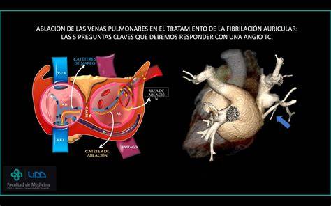 Representación de las técnicas de ablación de venas pulmonares