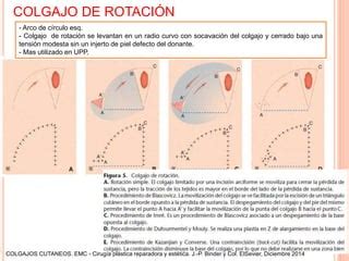 Esquema de las técnicas de injerto condromucoso y colgajo de rotación para la reconstrucción del párpado inferior